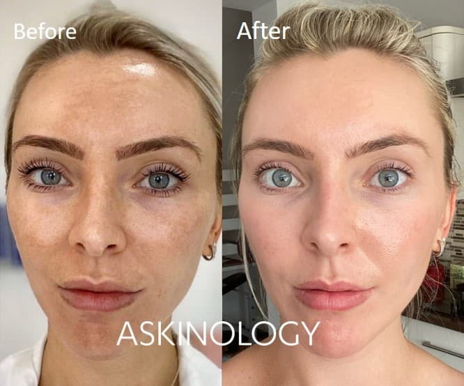 Cosmelan Peel before and after